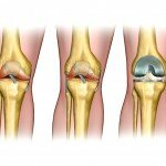 Эндопротезирования коленного сустава