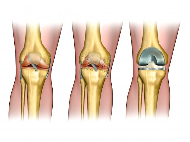 Эндопротезирования коленного сустава