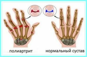 Полиартрит пальцев рук